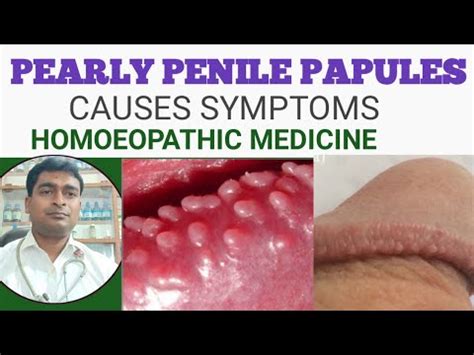 Pearly Penile Papules: Causes, Symptoms & Treatment